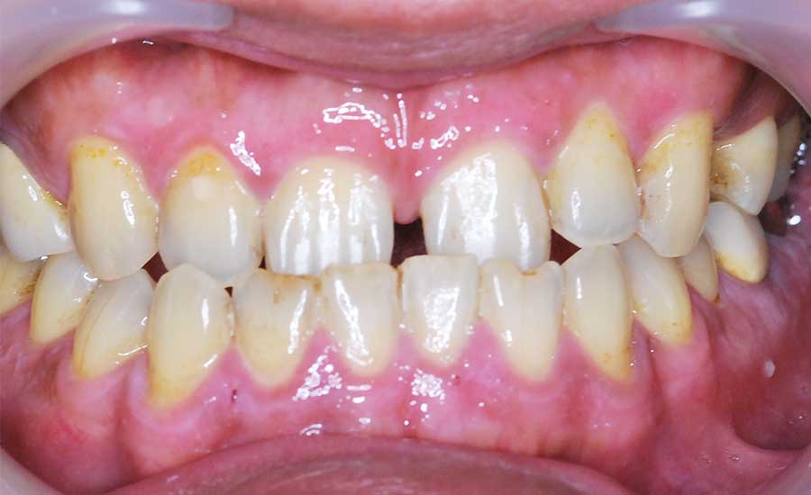 かさぶた状になってから、1〜2週間で綺麗なピンク色の歯茎が現れます