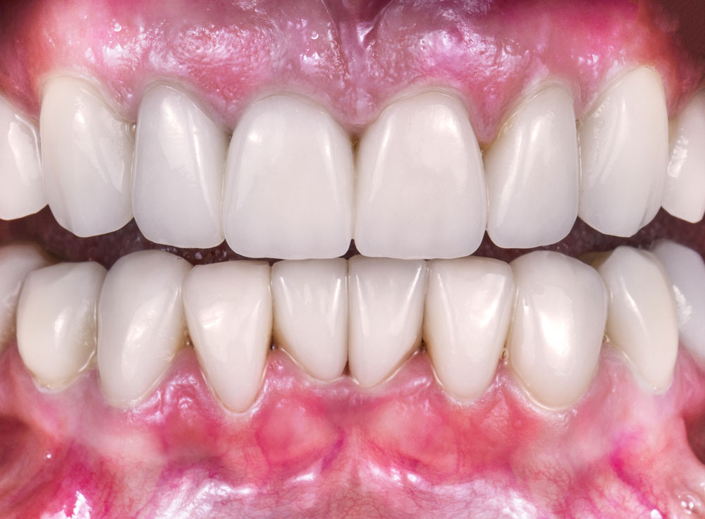 ガムピーリングで綺麗なピンク色の歯茎に戻すことができます