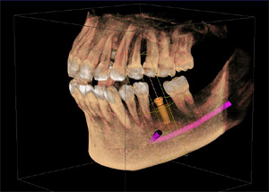 東新宿歯科 予防ケアクリニック ではCTを利用してインプラント治療のシミュレーションを行ってから施術を行うことが可能です