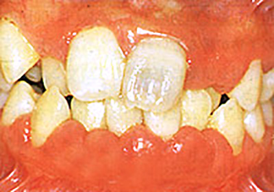 歯周病で腫れた歯茎