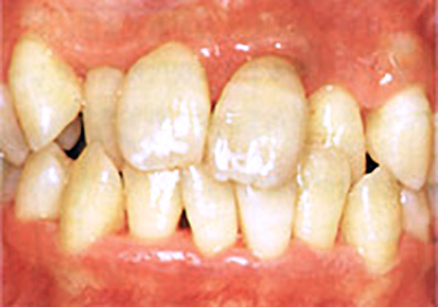 治療で改善した歯茎